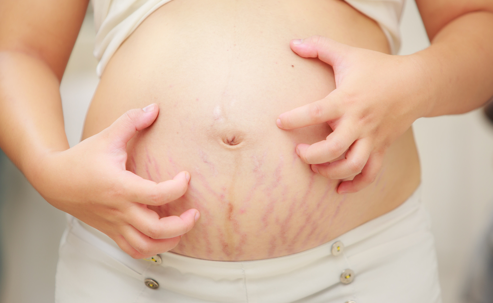 Những mẹo hay chữa trị rạn da sau sinh mà bà mẹ nào cũng cần phải biết