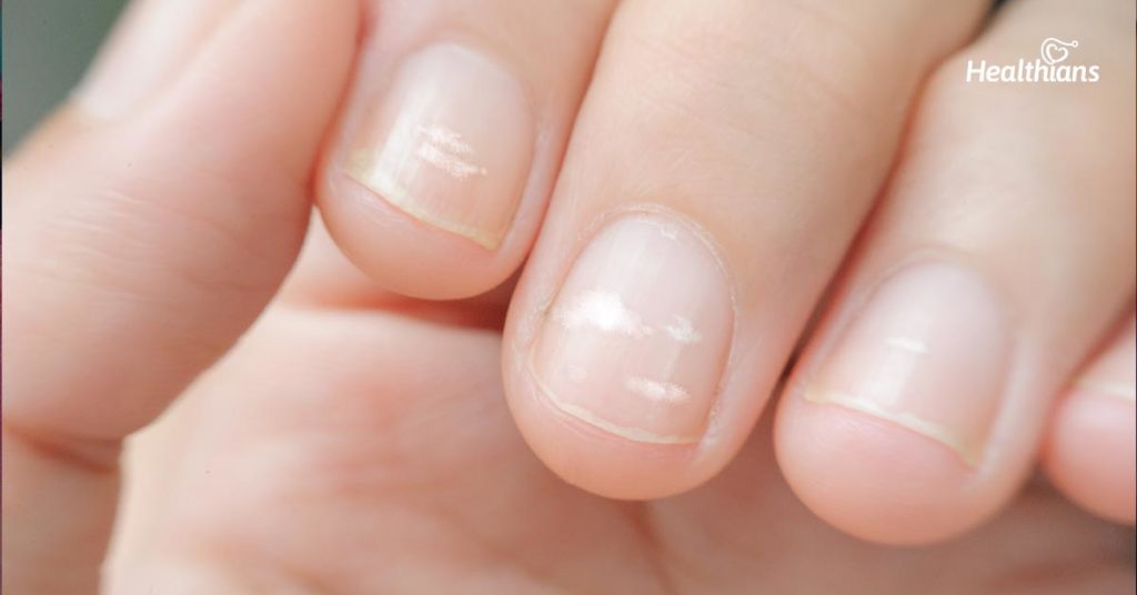 Tầm quan trọng, nhu cầu và ảnh hưởng của thiếu hụt canxi ở trẻ